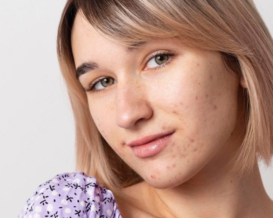 piel acnéica en adolescentes - tratamiento personalizado